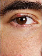 What causes styes?